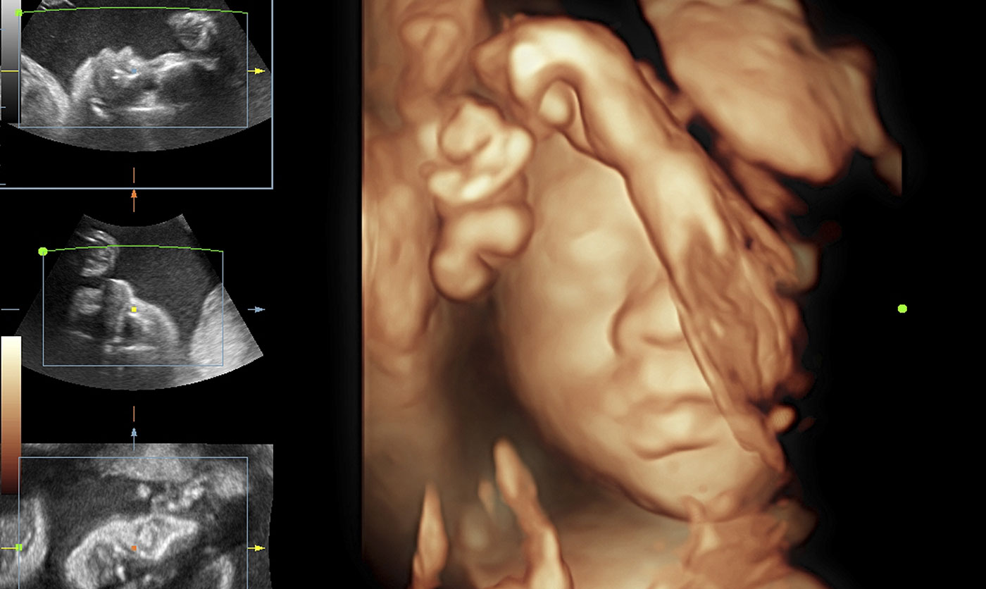 Kako se 4D ultrazvuk razlikuje od 3D ultrazvuka